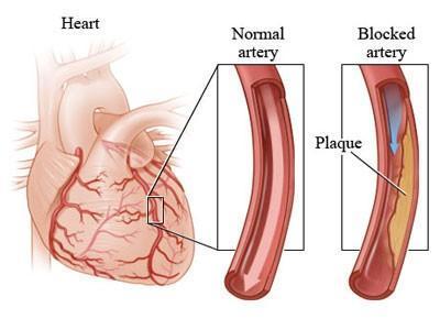 心肌缺血 心肌缺血-致病因素，心肌缺血-临床症状