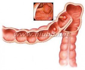 肠梗阻 肠梗阻-概述，肠梗阻-流行病学
