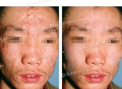 痤疮形成的原因 痤疮是怎么形成的,痤疮产生的原因
