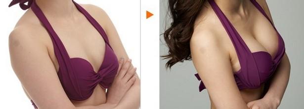 假体隆胸前后对比 假体隆胸前后照片对比