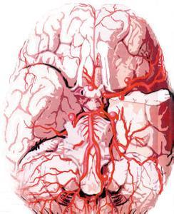 脑血管痉挛 脑血管痉挛-症状，脑血管痉挛-检查