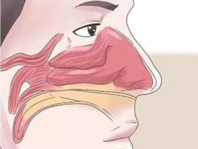 鼻塞 鼻塞-疾病概述，鼻塞-常见类型
