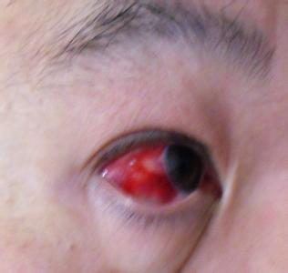 眼睛充血 眼睛充血-症状表现，眼睛充血-疾病种类