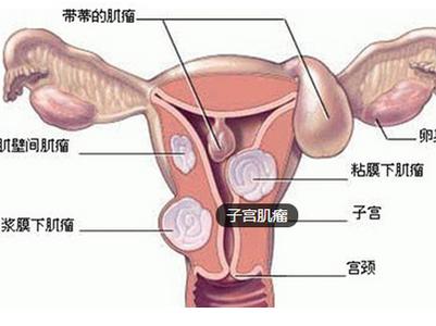 子宫腺肌病 子宫腺肌病-简介，子宫腺肌病-病因