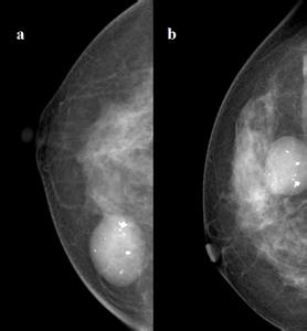 乳腺纤维腺瘤 乳腺纤维腺瘤-基本信息，乳腺纤维腺瘤-概述