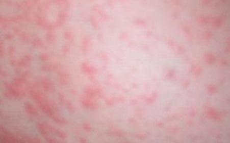 过敏性皮炎湿疹 过敏性皮炎湿疹-症状表现，过敏性皮炎湿疹-病因