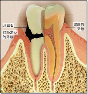 牙髓炎 牙髓炎-简介，牙髓炎-原因