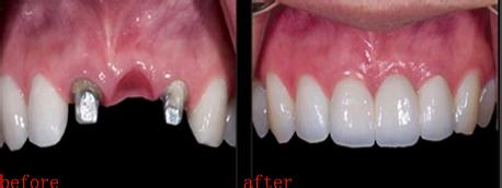 镶牙 镶牙-牙齿缺失危害，镶牙-拔牙镶牙时间