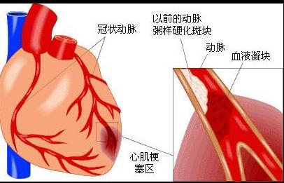 心脏主动脉夹层破裂 心脏破裂 心脏破裂-疾病描述，心脏破裂-临床表现