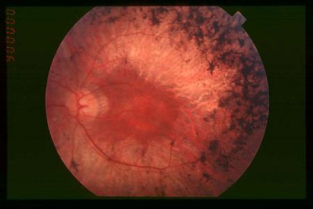 视网膜色素变性 视网膜色素变性-介绍，视网膜色素变性-相关信息