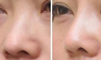 假体隆鼻一到7天恢复图 假体隆鼻能保持多久