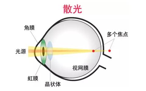 眼睛散光200的原因 眼睛散光的原因