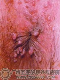 肛门生殖器疣 肛门生殖器疣-是什么？，肛门生殖器疣-症状愈合体