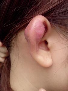 打耳洞后怎样才算发炎 打耳洞后发炎怎么办？