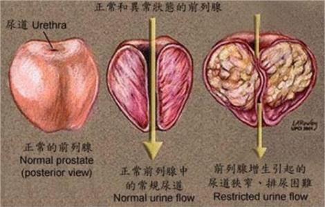 前列腺增生伴钙化 前列腺增生伴钙化-简介，前列腺增生伴钙化-症