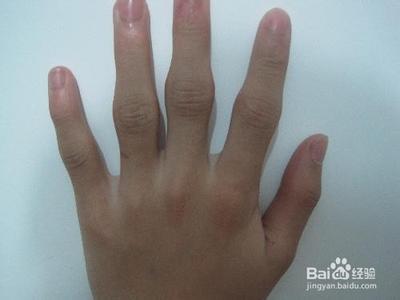 手指关节疼痛的原因 生活经验 [48]手指关节疼痛的原因有哪些