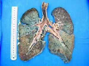 尘肺 尘肺-分类，尘肺-病因