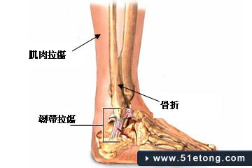 大腿韧带拉伤怎么办 韧带拉伤怎么办