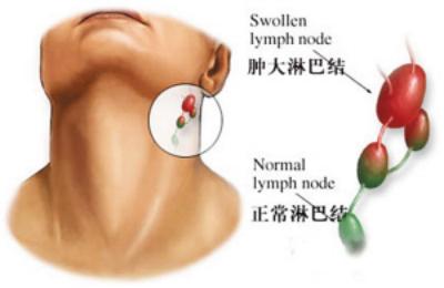 淋巴结肿大怎么消除 淋巴结肿大吃什么药