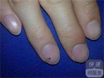 指甲上出现白斑 指甲出现白斑或提示肾虚