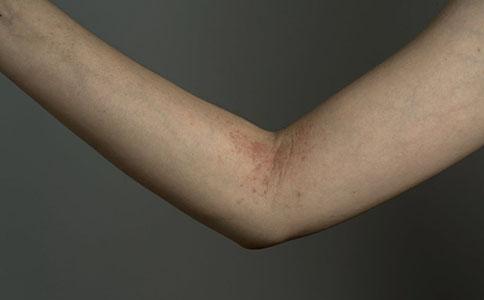 手臂皮肤过敏怎么办 手臂皮肤过敏这样处理