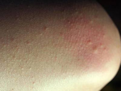 如何预防过敏性皮炎 如何预防秋季过敏性皮炎