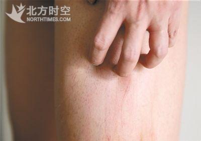 皮肤瘙痒病因 皮肤瘙痒的病因及治疗