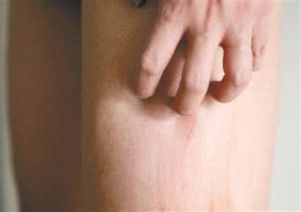 尿毒症皮肤瘙痒的原因 皮肤瘙痒的原因有哪些