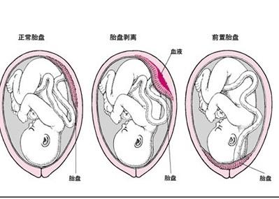 胎盘前置是什么意思 前置胎盘是什么意思_前置胎盘是怎样造成的(2)