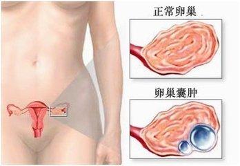 卵巢囊肿切除后能生育 卵巢囊肿手术后会影响生育吗