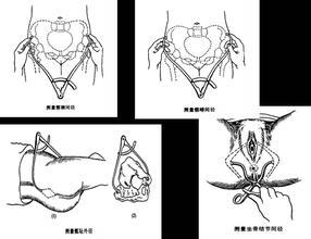 孕妇骨盆测量方法 骨盆测量方法