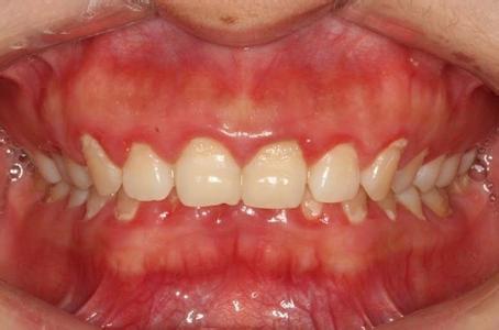 牙龈炎症 怎样有效治疗牙龈炎症