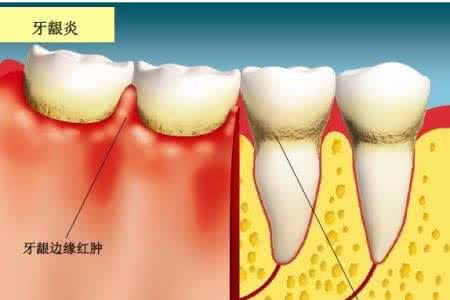 牙龈炎怎么治疗 牙龈炎怎么办_牙龈炎的中西医治疗方式