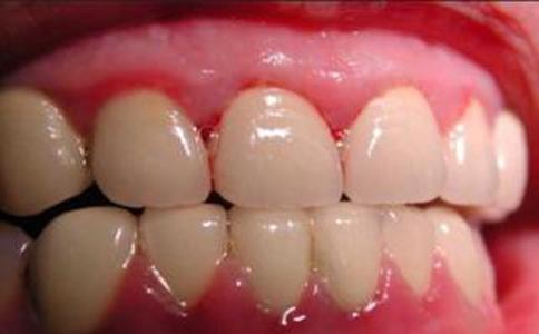 牙龈炎临床表现有 牙龈炎有什么表现