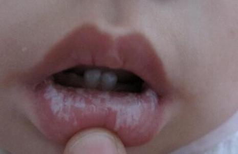 宝宝鹅口疮的症状图片 鹅口疮有什么症状