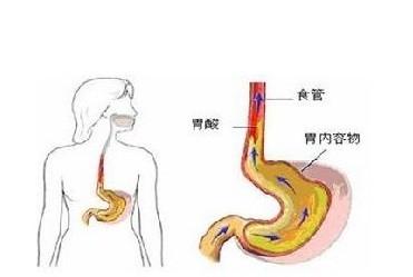 胃酸过多的症状用药 胃酸过多的症状