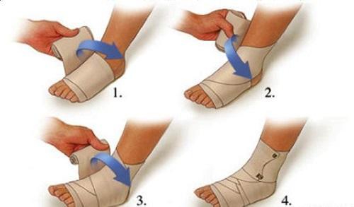 轻度急性脚踝关节扭伤 关节脱臼和急性扭伤的处理