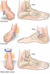 轻度急性脚踝关节扭伤 关节脱臼急性扭伤如何护理