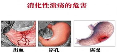 胃溃疡病症状 胃溃疡病有哪些症状？