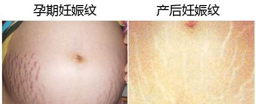 碧芙源祛产后妊娠纹 产后去妊娠纹有几个误区
