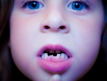 宝宝常见问题 宝宝换牙常见的六大问题