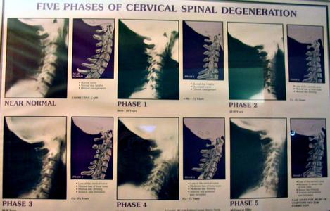 脊椎退化 解读脊椎退化的阶段