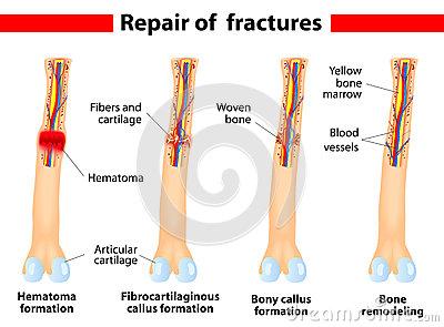 影响骨折愈合的因素 哪些因素影响骨折恢复