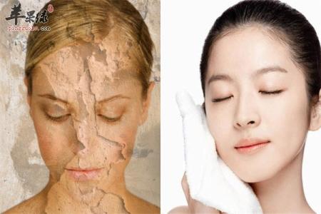 冬季皮肤干燥脱皮 冬季如何正确洗脸不让皮肤干燥脱皮