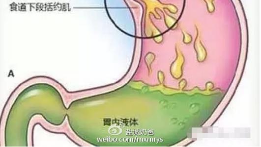 胃疼食管疼想呕吐 胃食管返流是宝宝呕吐的原因之一