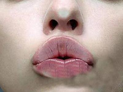 治疗嘴唇干裂的方法 干裂嘴唇护理常见方法