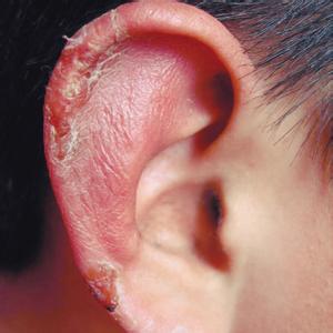 耳朵外面痒是怎么回事 耳朵痒是怎么回事