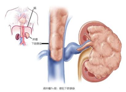 肾癌病因 肾癌的病因有哪些