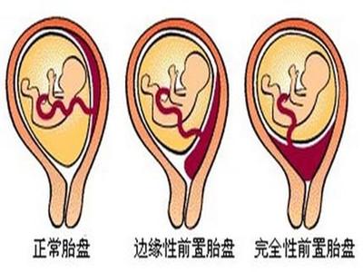 胎盘子宫前壁是前怀吗 胎盘位于子宫前壁正常吗