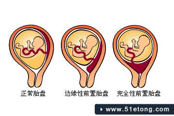 前置胎盘注意事项 前置胎盘有哪些注意事项